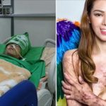遭遇八仙塵爆「火吻40秒」全身90%燒傷,曾因外貌自卑封閉, 現在浴火重生感動萬民