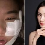 女粉絲豪擲450萬想變成楊冪,紗布全拆後驚艷網民「比本尊還美欸!」