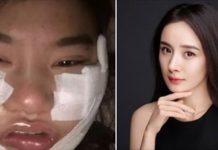 女粉絲豪擲450萬想變成楊冪,紗布全拆後驚艷網民「比本尊還美欸!」