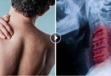 出事了!愛扭脖子扭到「喀喀作響」的看 28歲男頸動脈分離半身慘沒知覺