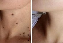 只用2種材料就能天然去除疣!