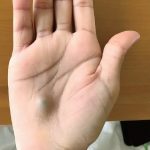 他看完牙醫後手上長出一顆藍色小球,又在短時間內掉了12公斤,嚇得他趕快去醫院求助!