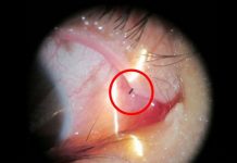 OL的眼瞼發現「小黑點」原以為是砂子…醫生:沒想到越拉越長!