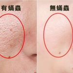 你以為的白頭粉刺竟然是蟎蟲尾巴「讓專家告訴你如何分辨」亂處理皮膚會更凹凸喔!