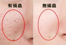 你以為的白頭粉刺竟然是蟎蟲尾巴「讓專家告訴你如何分辨」亂處理皮膚會更凹凸喔!