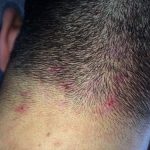 為什麼頭皮老是「長痘痘還一直長出來」!原因竟然是「這個」以後不要做這種事了!不然還會一直長!!