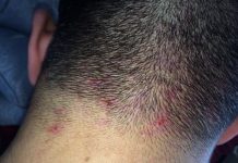 為什麼頭皮老是「長痘痘還一直長出來」!原因竟然是「這個」以後不要做這種事了!不然還會一直長!!