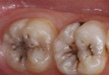 牙齒上的神秘「黑線」,千萬別用手摳!不然後果不堪設想!