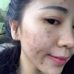 為什麼會一夜爆痘