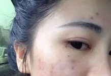 為什麼會一夜爆痘