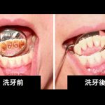 洗牙後齒縫變很大還很酸…..搞懂洗牙迷思!