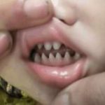 孩子嘴裡長出尖銳「鯊魚齒」父母覺得超霸氣 醫生:害了他