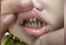 孩子嘴裡長出尖銳「鯊魚齒」父母覺得超霸氣 醫生:害了他
