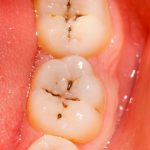 牙齒上的小黑斑「為什麼刷不乾淨也摳不掉」?牙醫告訴你真相!