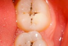 牙齒上的小黑斑「為什麼刷不乾淨也摳不掉」?牙醫告訴你真相!