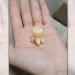 他曬「大顆智齒照」居然有點可愛 網驚:還以為是小章魚