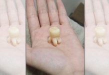 他曬「大顆智齒照」居然有點可愛 網驚:還以為是小章魚