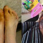 一起床發現腳異常反黑,以為得了怪病…得知「病因」差點受不了!!!