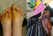 一起床發現腳異常反黑,以為得了怪病…得知「病因」差點受不了!!!