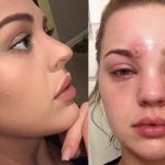 正妹以為眼睛上面的只是普通痘痘,擠掉後她卻「差點眼瞎」嚇到警告大家不要學她