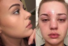 正妹以為眼睛上面的只是普通痘痘,擠掉後她卻「差點眼瞎」嚇到警告大家不要學她